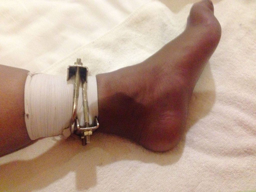 绳缚紧压左腿后的脚部状态 / Foot condition after tight rope restraint
