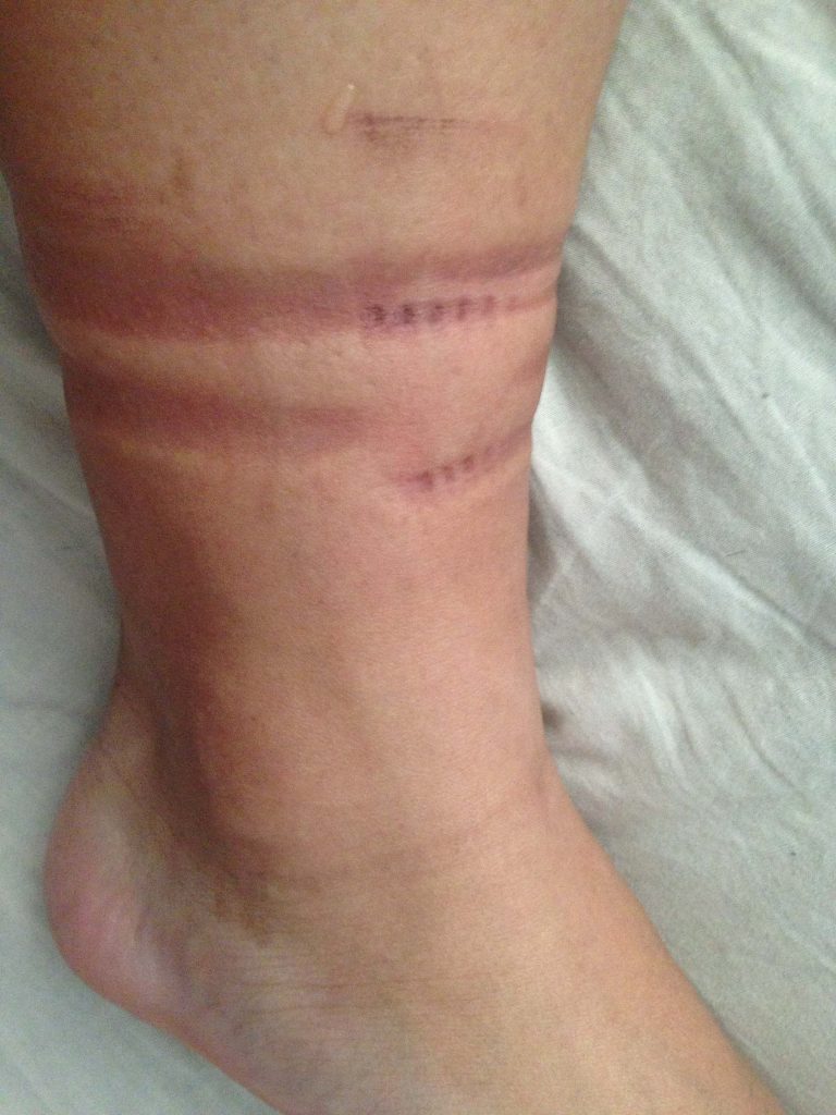 左腿紧缚捆绑整体与足部变化 / Overall left leg bondage and foot changes