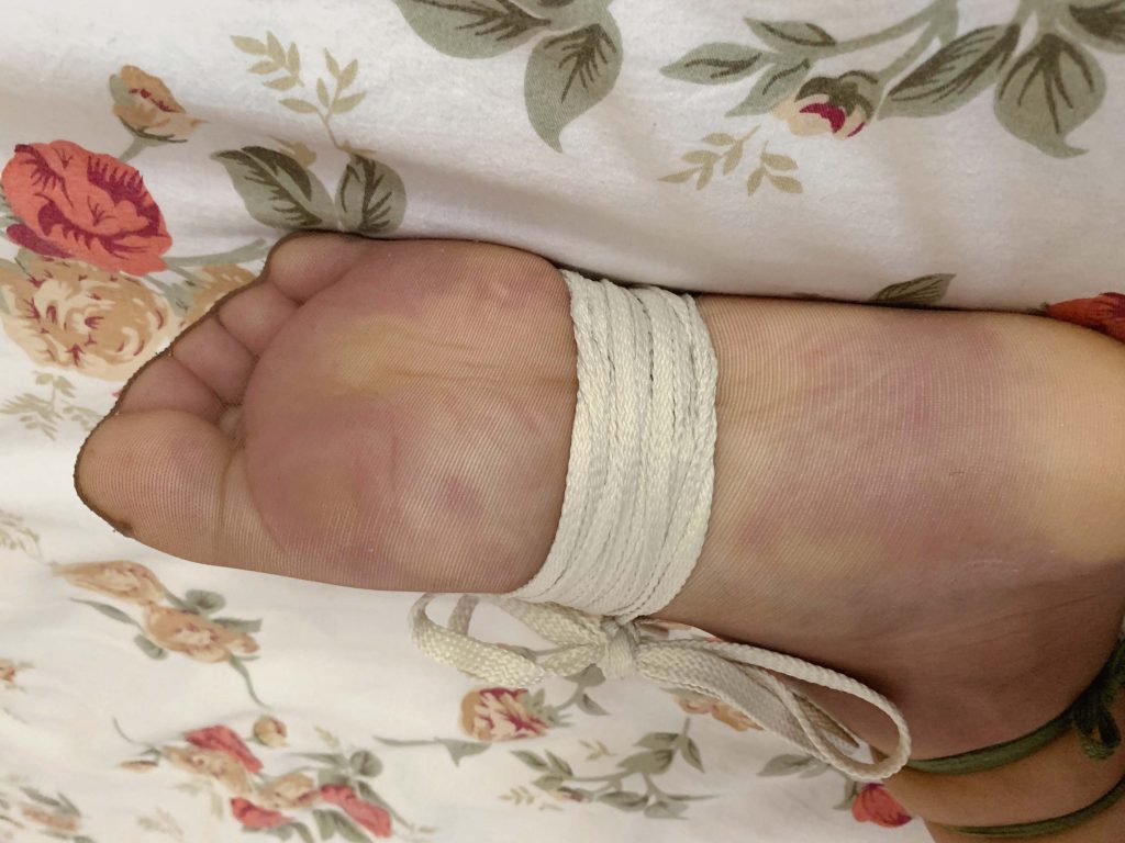 左腿捆绑后脚丫深色变化 / Dark foot discoloration after left leg bondage