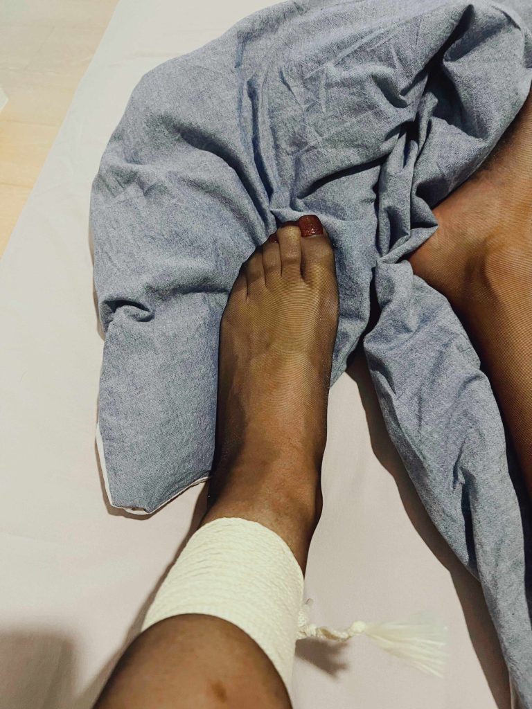 左腿绳缚与脚趾发暗变化 / Darkened toes after left leg rope bondage