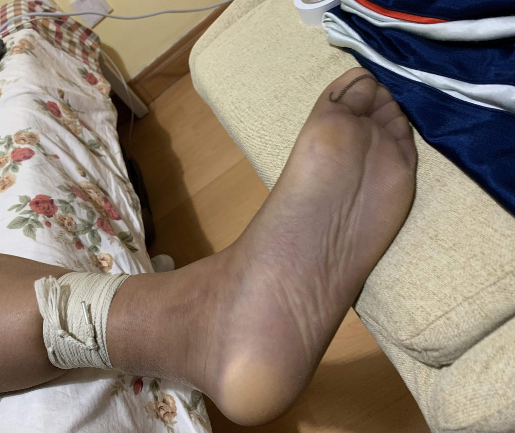 左腿束缚与脚丫发紫发暗 / Left leg bondage with dark purple foot