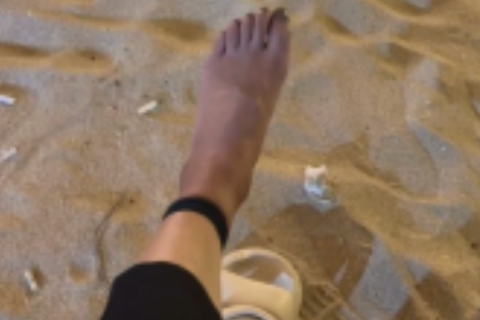 巴厘岛海滩用餐时左脚皮筋捆绑后的颜色变化 / Left foot discoloration after rubber-band bondage while dining at a Bali beach